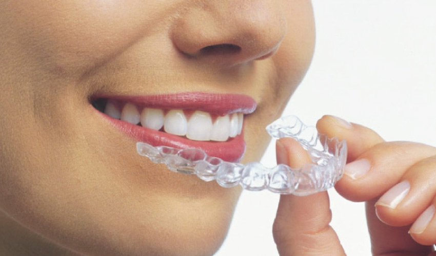 woman inserting clearcorrect orthodontic aligners